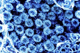 Virus gây bệnh Covid-19 có thể gây viêm não tương tự bệnh Parkinson