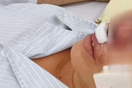 Vi khuẩn gây bệnh Whitmore nguy hiểm như thế nào?