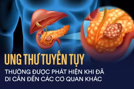 Bệnh ung thư tụy khó phát hiện, gây tử vong nhanh