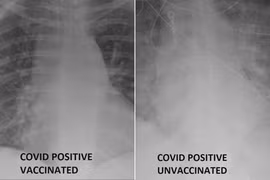 Sự khác nhau giữa phổi bệnh nhân Covid-19 được tiêm và không tiêm vaccine