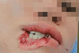 Cô ruột cắn cháu gái đứt lìa 1/3 môi