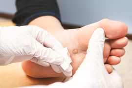 Mụn cóc và thuốc