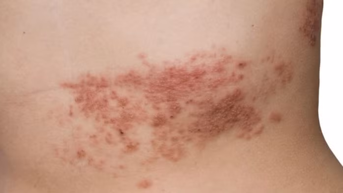 Biểu hiện của zona thần kinh