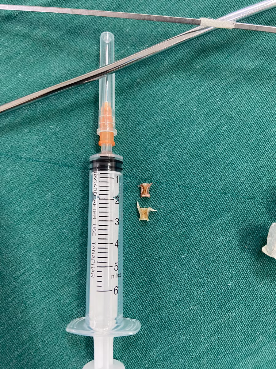 Dị vật được lấy ra từ bệnh nhi A Tuần. Ảnh bác sĩ cung cấp Dị vật được lấy ra từ bệnh nhi A Tuần. Ảnh bác sĩ cung cấp