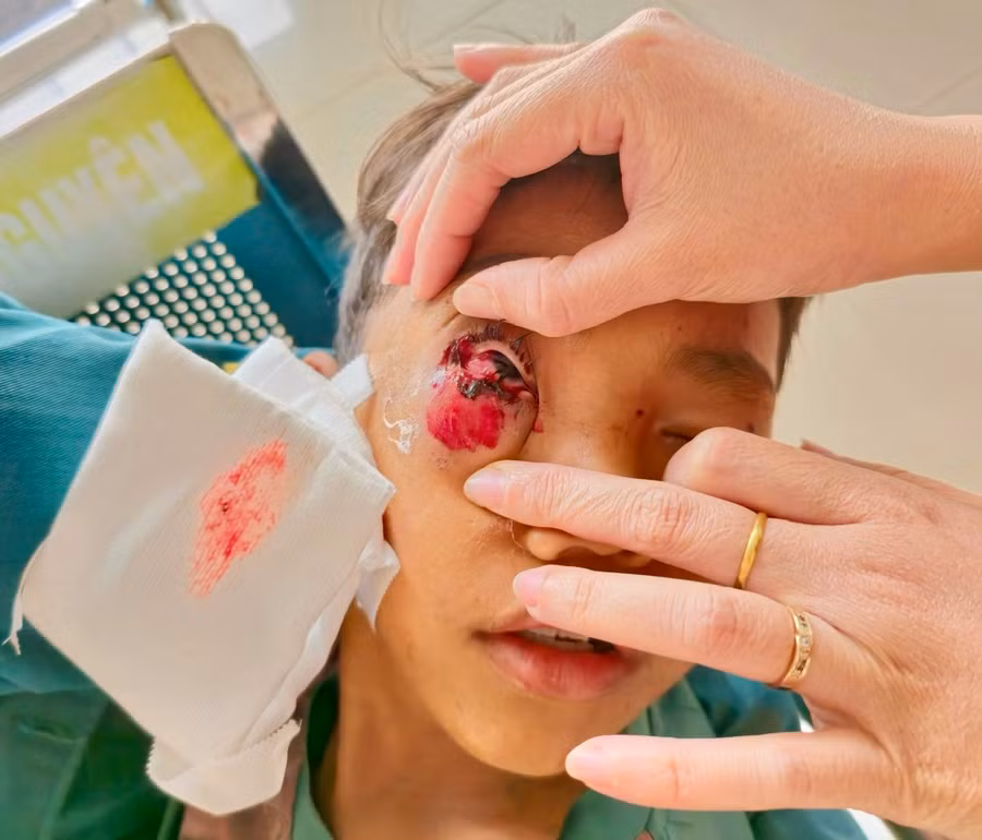 Một ca cấp cứu do pháo nổ tại Bệnh viện Mắt Cao Nguyên. Ảnh: Đơn vị cung cấp