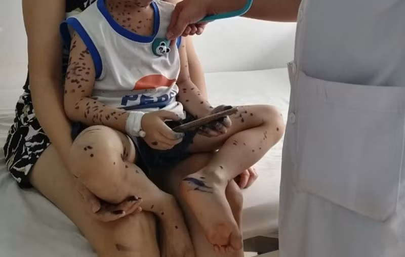 Nếu không phòng, chống dịch đúng cách, dịch thủy đậu sẽ lây lan nhanh trong cộng đồng.