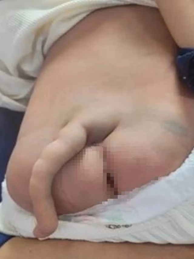 Bé P. bị dị tật mọc "đuôi" dài 14 cm Bé P. bị dị tật mọc "đuôi" dài 14 cm