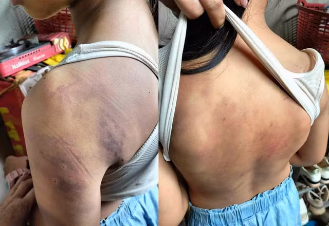 Các vết thương trên người em U. sau khi bị 10 bạn học đánh. NGƯỜI DÂN CUNG CẤP