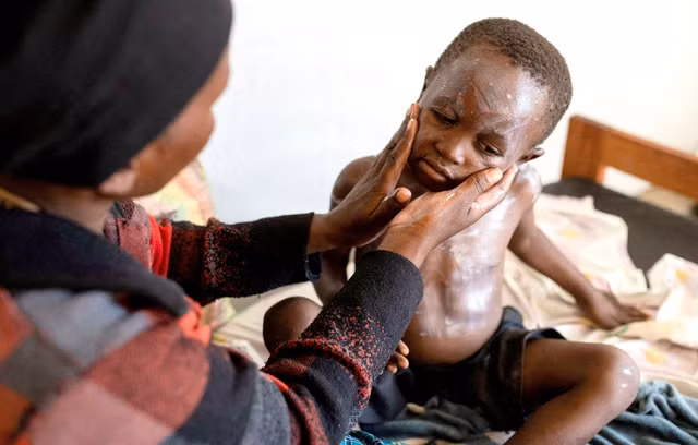 Một em bé mắc đậu mùa khỉ ở CHDC Congo. Ảnh: Reuters