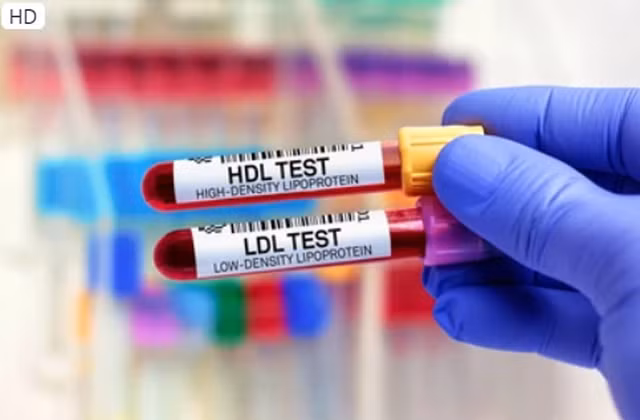 Cholesterol cao có thể gây đau tim và đột quỵ. Ảnh: Shutterstock
