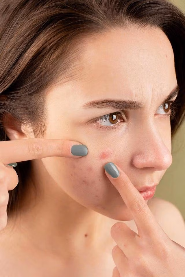 Các bác sĩ chuyên khoa da liễu khuyên chúng ta không nên nặn mụn vì có thể làm tăng nguy cơ nhiễm trùng từ vi khuẩn trên tay của mình hoặc nhân viên chăm sóc da. Ảnh minh họa: Pexels