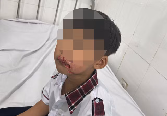 Đang chờ phụ huynh đến đón, 2 em học sinh bất ngờ bị chó béc-giê cắn - Ảnh 1. Em học sinh bị chó béc-giê cắn thương tích. Ảnh: CTV