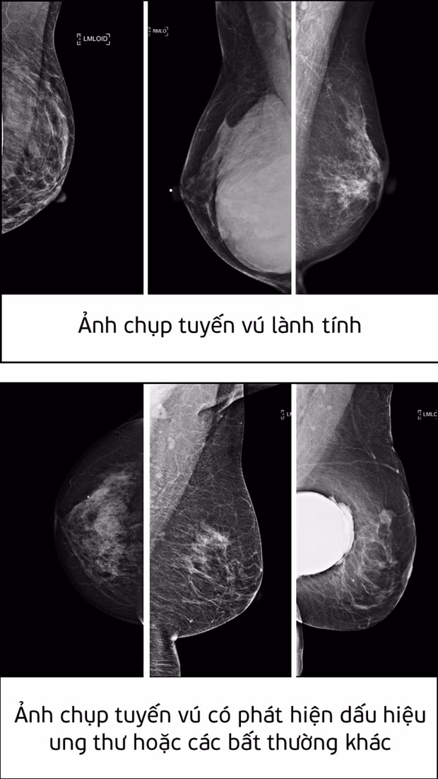 Ảnh chụp tuyến vú lành tính và ảnh chụp tuyến vú có phát hiện dấu hiệu ung thư hoặc các bất thường khác.