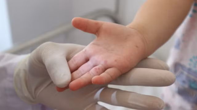 Bệnh tay chân miệng thường xuất hiện ở trẻ em dưới 5 tuổi. Ảnh: SỞ Y TẾ ĐẮK LẮK Bệnh tay chân miệng thường xuất hiện ở trẻ em dưới 5 tuổi. Ảnh: SỞ Y TẾ ĐẮK LẮK