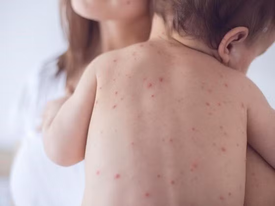 Đắk Lắk ghi nhận 2 ổ dịch thủy đậu. Ảnh minh họa Đắk Lắk ghi nhận 2 ổ dịch thủy đậu. Ảnh minh họa