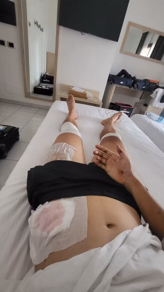 Nguyễn Thị Thật bị đa chấn thương khi gặp tai nạn trong lúc đổ đèo chặng 8. Ảnh: NVCC