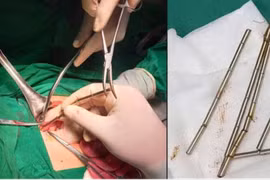 Bệnh viện Đa khoa Trung tâm tỉnh Gia Lai phẫu thuật thành công lấy 25 viên nam châm trong đường tiêu hóa bệnh nhi.