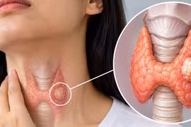 Người trẻ cũng mắc ung thư tuyến giáp: 4 yếu tố nguy cơ cần biết