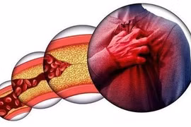 Gần một nửa dân số Việt Nam đang đối mặt nguy cơ tim mạch