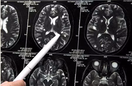 Hình ảnh cho thấy sán làm tổ trong não.