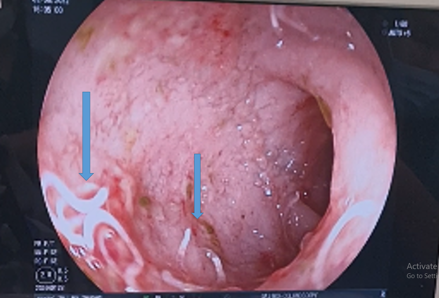 Nội soi tiêu hóa ghi nhận nhiều giun ở tá tràng, gây viêm loét chảy máu niêm mạc đường tiêu hóa. Ảnh BSCC