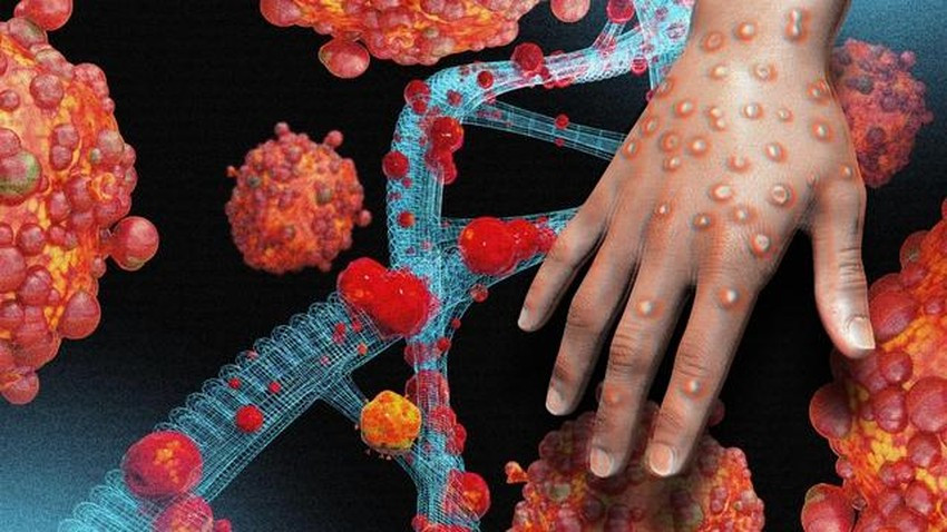 Một hình thái tổn thương do nhiễm virus đậu mùa khỉ. Ảnh: Internet