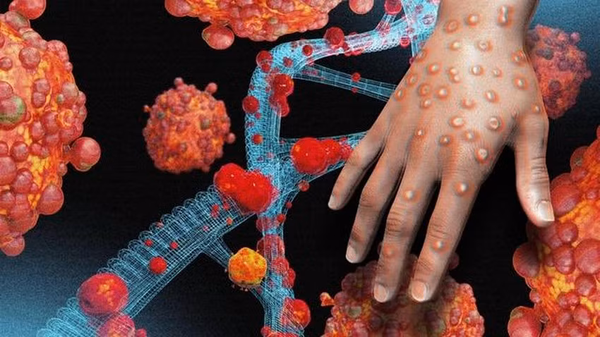 Một hình thái tổn thương do nhiễm virus đậu mùa khỉ. Ảnh: Internet