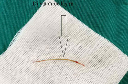 Xương cá dài 4 cm được bác lấy ra khỏi bụng bệnh nhân.