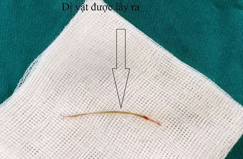 Xương cá dài 4 cm được bác lấy ra khỏi bụng bệnh nhân.