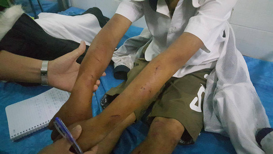 Cháu A. bị cha đánh bầm dập khắp cơ thể Cháu A. bị cha đánh bầm dập khắp cơ thể