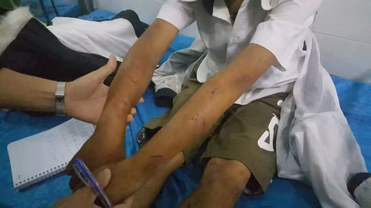 Cháu A. bị cha đánh bầm dập khắp cơ thể