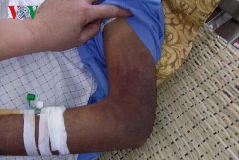 Cánh tay của ông N bị con đánh đến bầm tím.