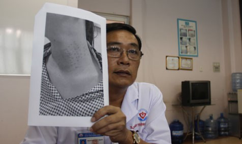  Một phụ nữ bị biến chứng vùng cổ khi đi thẩm mỹ