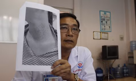  Một phụ nữ bị biến chứng vùng cổ khi đi thẩm mỹ