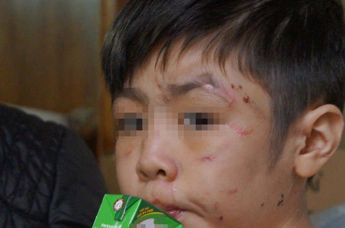 Bé trai 10 tuổi với nhiều vết thương trên mặt. Ảnh: Q.Anh.
