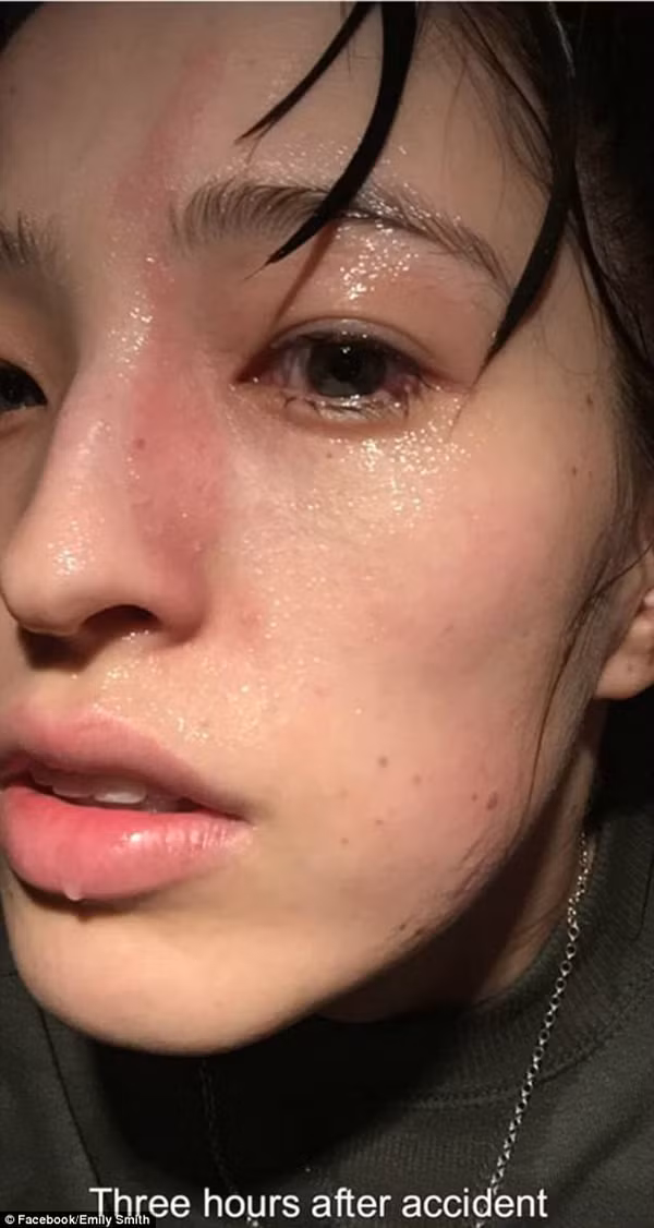  Ba tiếng sau, khuôn mặt Emily xuất hiện vết bỏng nhẹ.