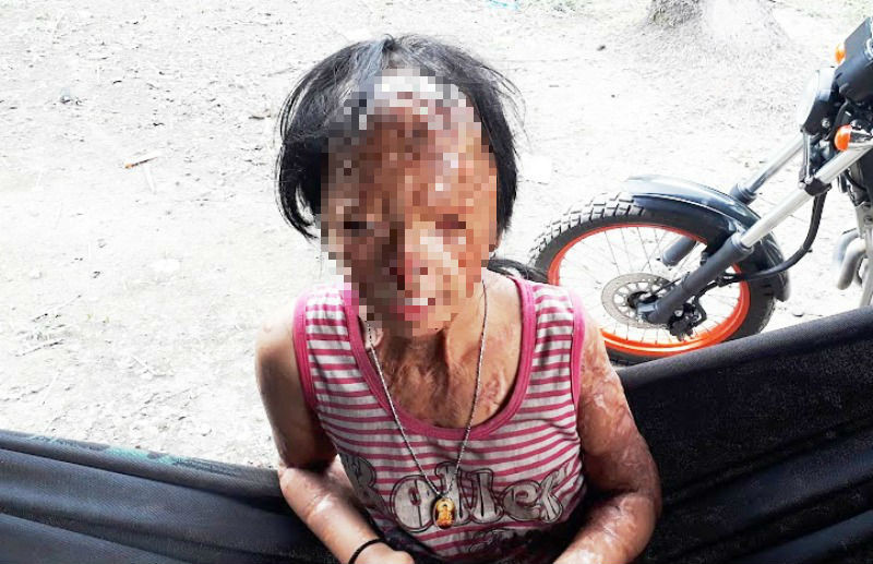  Bé N., nạn nhân bị tình địch của mẹ tạt a xít đến tàn phế 