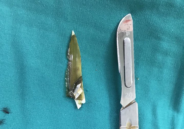 Mảnh dị vật là mảnh ốc 