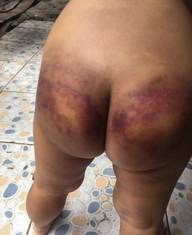 có nhiều vết thương xuất hiện trên cơ thể bé T, bà ngoại nghi ngờ mẹ ruột cùng cha dượng bạo hành dã man. có nhiều vết thương xuất hiện trên cơ thể bé T, bà ngoại nghi ngờ mẹ ruột cùng cha dượng bạo hành dã man.