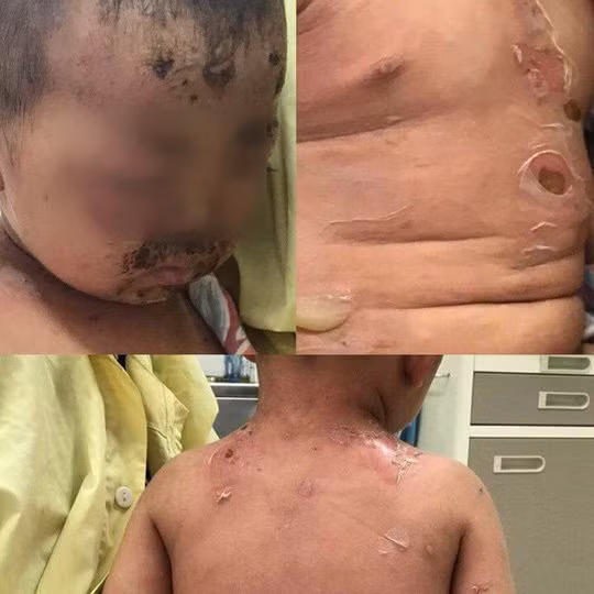  Bé L. đau đớn do các vết viêm loét da kèm bọng mủ