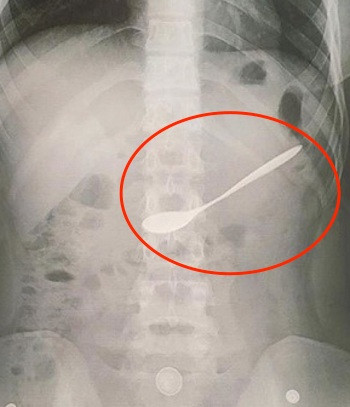  Hình ảnh chụp X - Quang chiếc thìa trong dạ dày trước lúc gắp. Ảnh: Bác sĩ cung cấp.