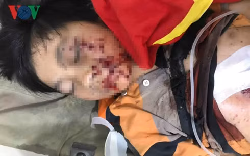 Cháu Tuấn bị nhiều vết thuơng ở vùng mặt, ngực, tay do vừa sạc pin điện thoại vừa chơi game. Cháu Tuấn bị nhiều vết thuơng ở vùng mặt, ngực, tay do vừa sạc pin điện thoại vừa chơi game.