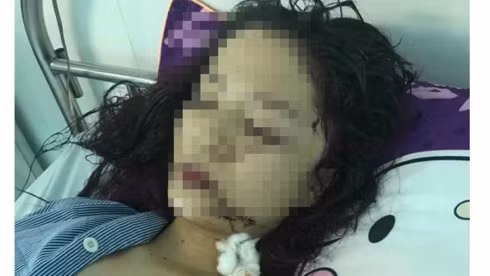 Nạn nhân phải đi cấp cứu và khâu 60 mũi.