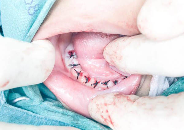 Các bác sĩ đã phải khâu nướu lại sau khi nhổ răng để cầm máu cho Nong Kaa.