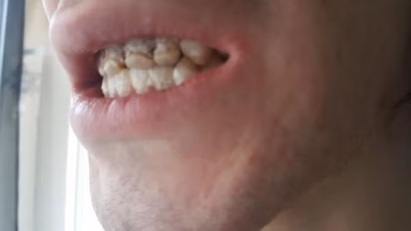 4 chiếc răng cửa của Vinnie bị ăn mòn và gãy bởi nước tăng lực.