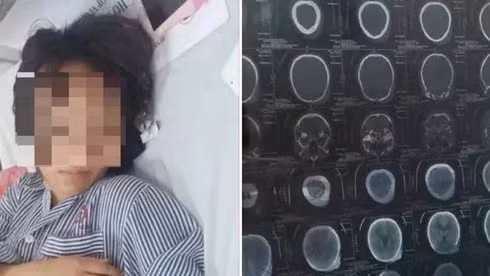  Nữ sinh PTTH ở Quảng Ninh bị khoảng 10 bạn đấm đá, giẫm đạp đến nhập viện