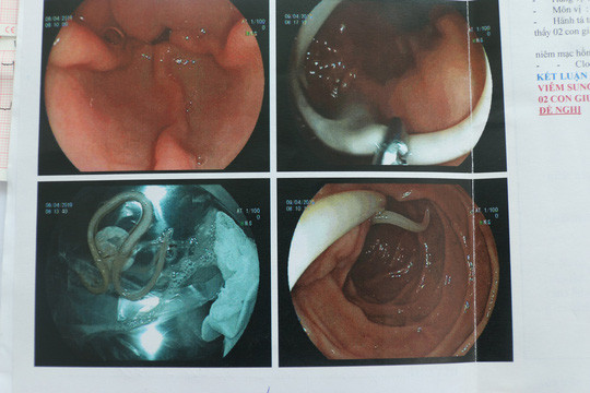 Loại ký sinh trùng gây đau bụng dữ dội cho bệnh nhân