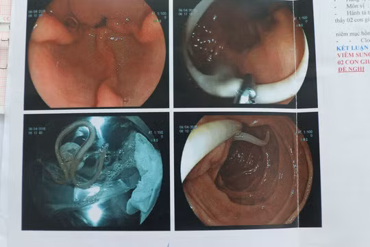 Loại ký sinh trùng gây đau bụng dữ dội cho bệnh nhân