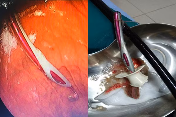 Chiếc bàn chải chui tọt vào dạ dày cô gái.