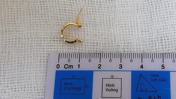  Chiếc bông tai được gắp ra khỏi dạ dày bé gái.